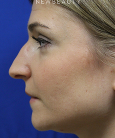 dr-jennifer-levine-rhinoplasty-b