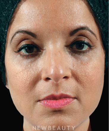 dr-marina-peredo-injectables-fillers-b