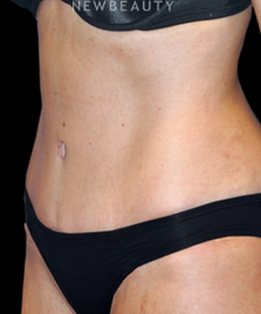 dr-bryan-w-gawley-tummy-tuck-with-lipo-b