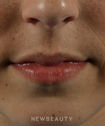 dr-marina-peredo-restylane-b