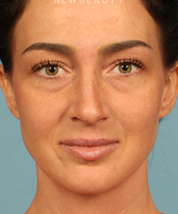 dr-raman-mahabir-lower-eyelid-b