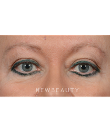 dr-jeffrey-wise-facelift-b