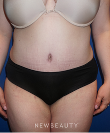 dr-niki-a-christopoulos-tummy-tuck-b