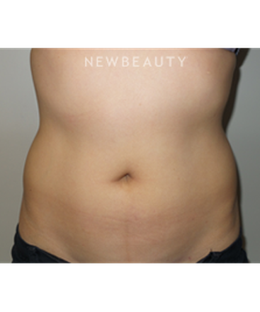 dr-sanjay-grover-coolsculpting-b