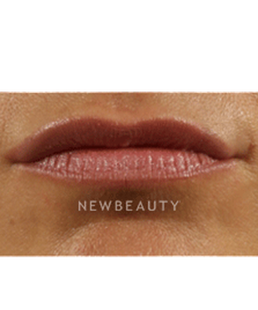 dr-marina-peredo-lip-augmentation-b