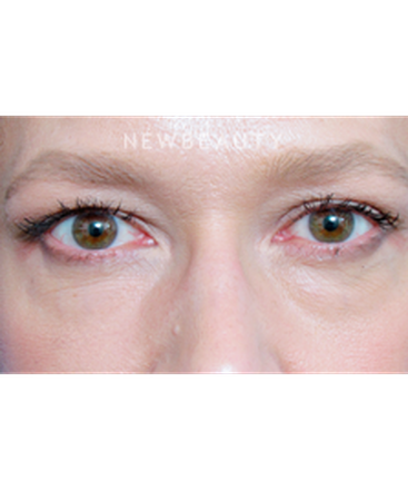 dr-raymond-douglas-under-eye-filler-b