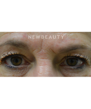 dr-baljeet-k-purewal-upper-blepharoplasty-b