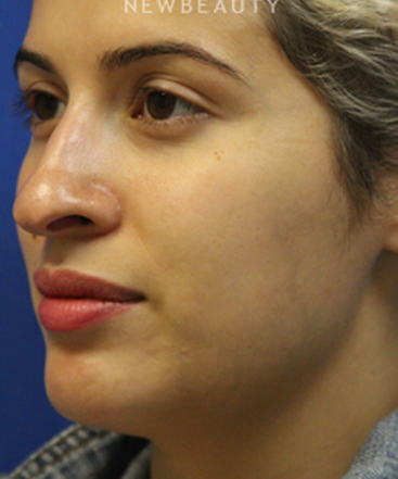 dr-jennifer-levine-rhinoplasty-b