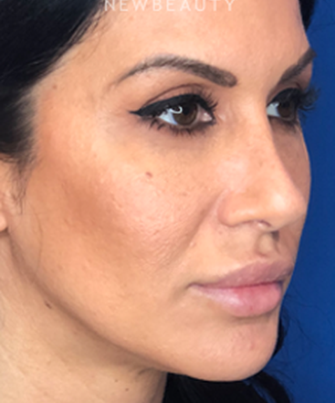 dr-jennifer-levine-rhinoplasty-b