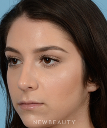 dr-jeffrey-b-wise-rhinoplasty-b