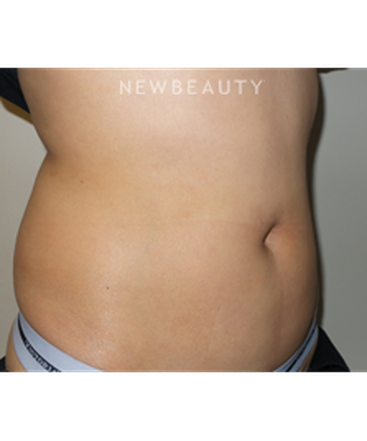 dr-sanjay-grover-coolsculpting-b
