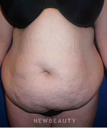 dr-niki-a-christopoulos-tummy-tuck-b