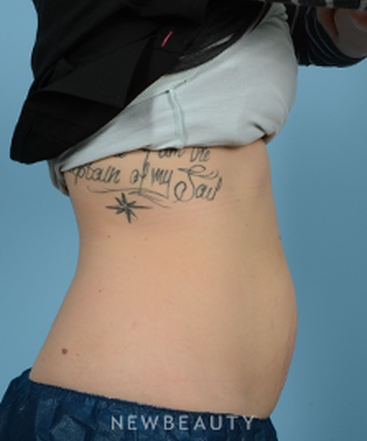 dr-jeffrey-wise-coolsculpting-b