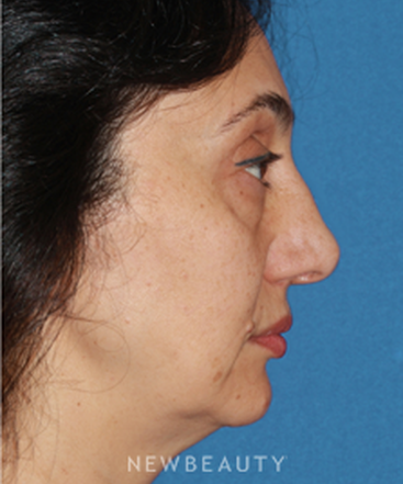 dr-konstantin-vasyukevich-traditional-facelift-b