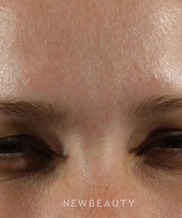 dr-marina-peredo-botox-b
