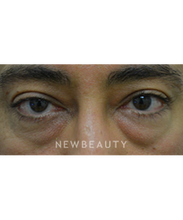 dr-baljeet-k-purewal-blepharoplasty-b