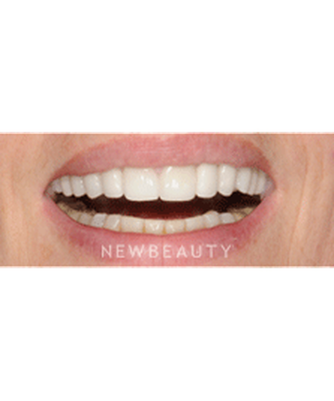 dr-ronald-goldstein-crowns-gum-countouring-veneers-b