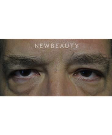 dr-baljeet-k-purewal-blepharoplasties-b
