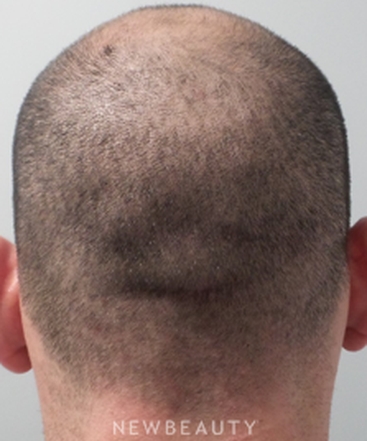 dr-marina-peredo-hair-loss-treatment-b