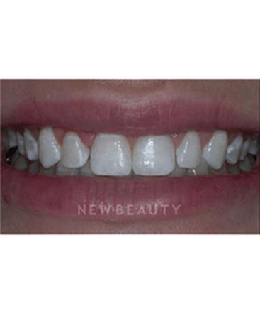 dr-guy-lewis-veneers-b