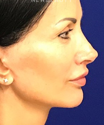 dr-dilip-madnani-minilift-injectables-b