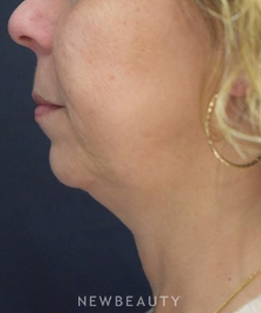 dr-jeffrey-b-wise-ultherapy-juvederm-b