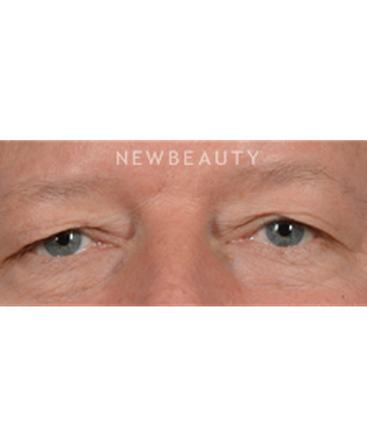 dr-jeffrey-b-wise-upper-blepharoplasty-b