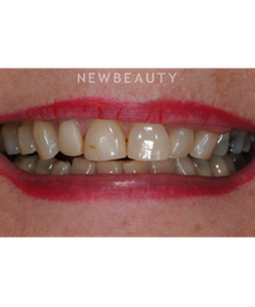 dr-ronald-goldstein-smile-makeover-b