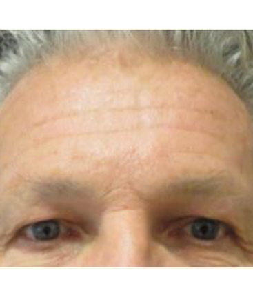 dr-kim-nichols-botox-b