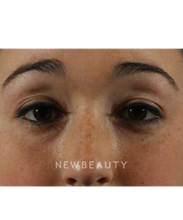 dr-marina-peredo-restylane-b
