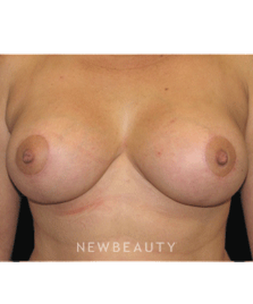dr-sean-simon-breast-reduction-breast-lift-b