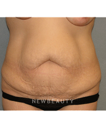 dr-sean-simon-tummy-tuck-lipo-b