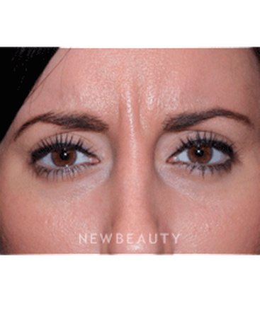 dr-marina-peredo-botox-b