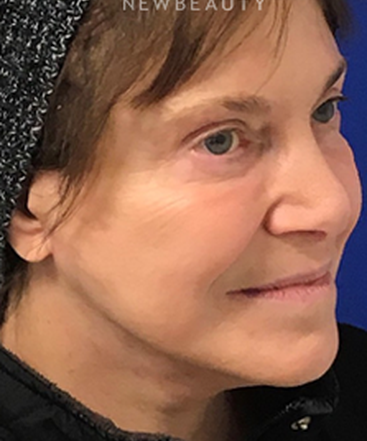 dr-dilip-madnani-facial-rejuvenation-b
