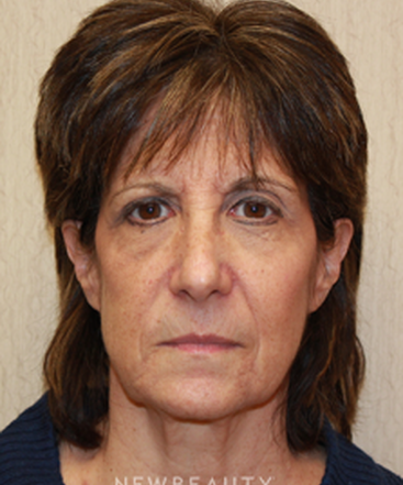 dr-dilip-d-madnani-facelift-necklift-eyelift-b