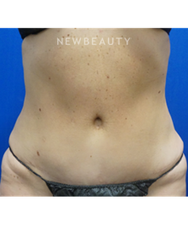 dr-niki-christopoulos-tummy-tuck-b