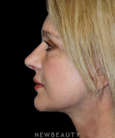 dr-brent-smith-upper-blepharoplasty-necklift-b
