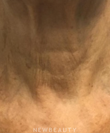 dr-marina-peredo-botox-b