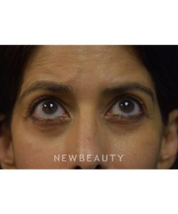 dr-jeffrey-b-wise-blepharoplasty-b