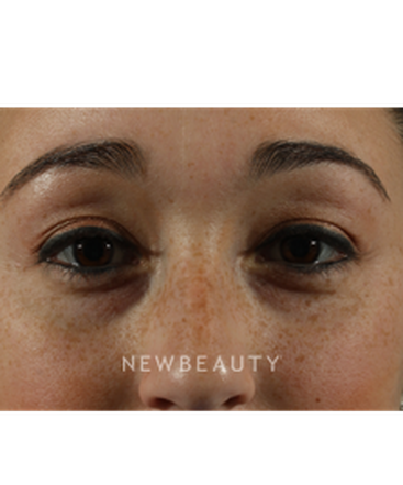 dr-marina-peredo-restylane-b
