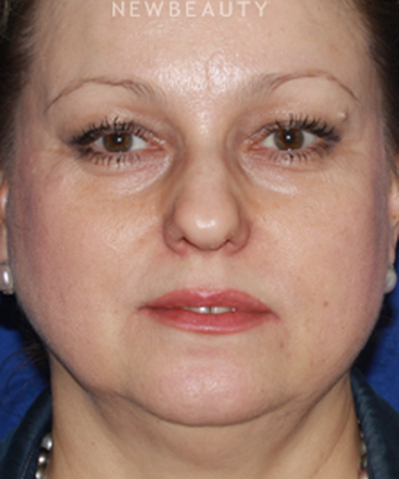 dr-konstantin-vasyukevich-facelift-b