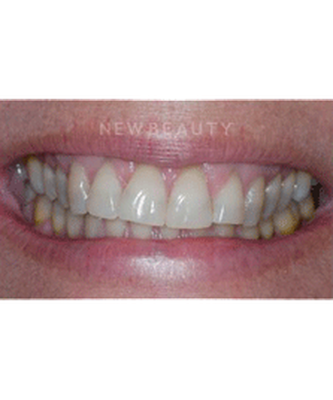 dr-guy-lewis-veneers-b