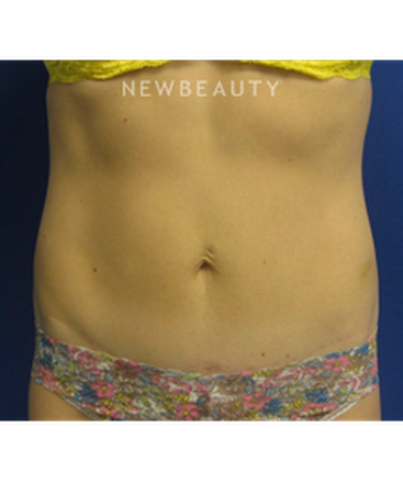 dr-niki-christopoulos-tummy-tuck-b