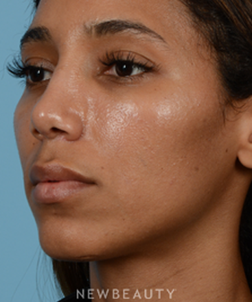 dr-jeffrey-b-wise-nasal-tip-refinement-b