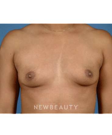 dr-bradley-calobrace-breast-augmentation-b