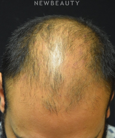 dr-jeffrey-b-wise-hair-transplant-for-hair-loss-b