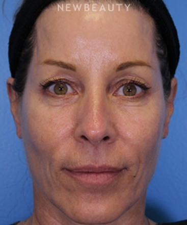 dr-ava-shamban-full-facial-rejuvenation-b