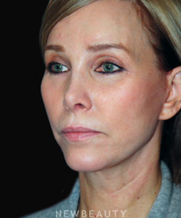 dr-brent-smith-facelift-rhinoplasty-lasers-chin-augmentation-b