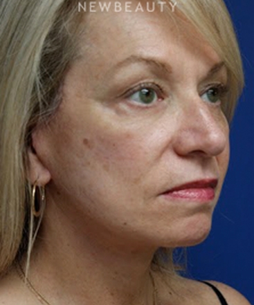 dr-joseph-russo-rejuvenated-look-face-ebg-b