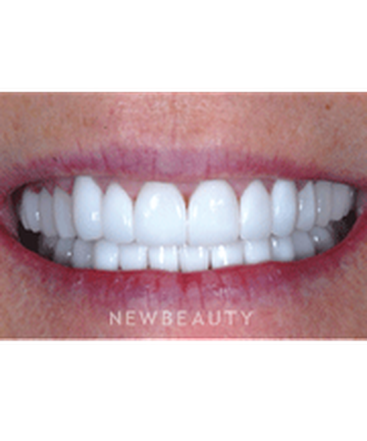 dr-guy-m-lewis-smile-makeover-b